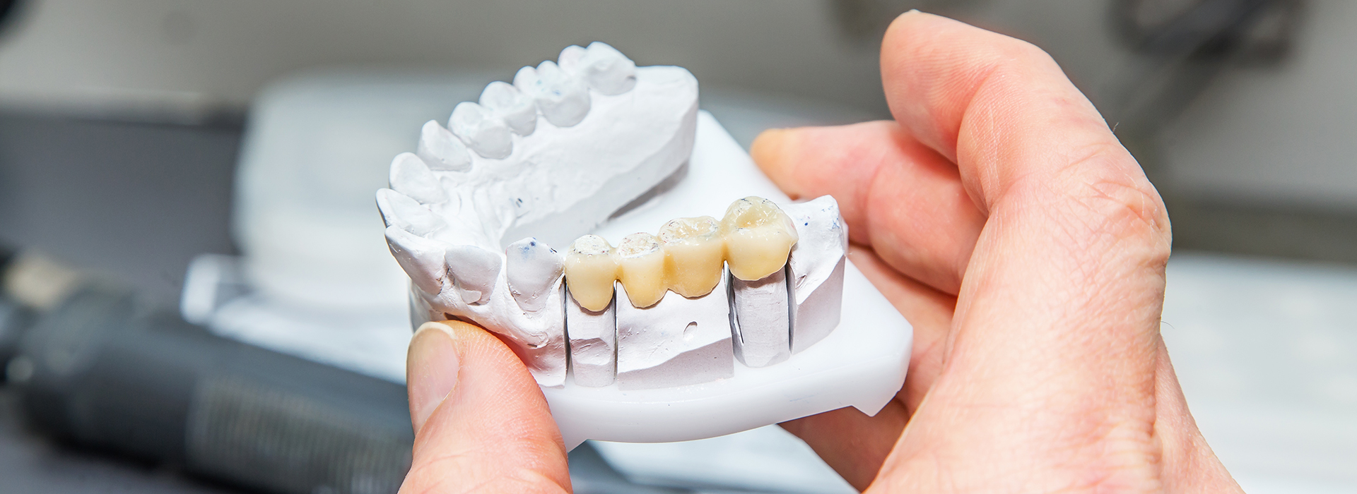 Person holding a white dental model with multiple teeth missing.