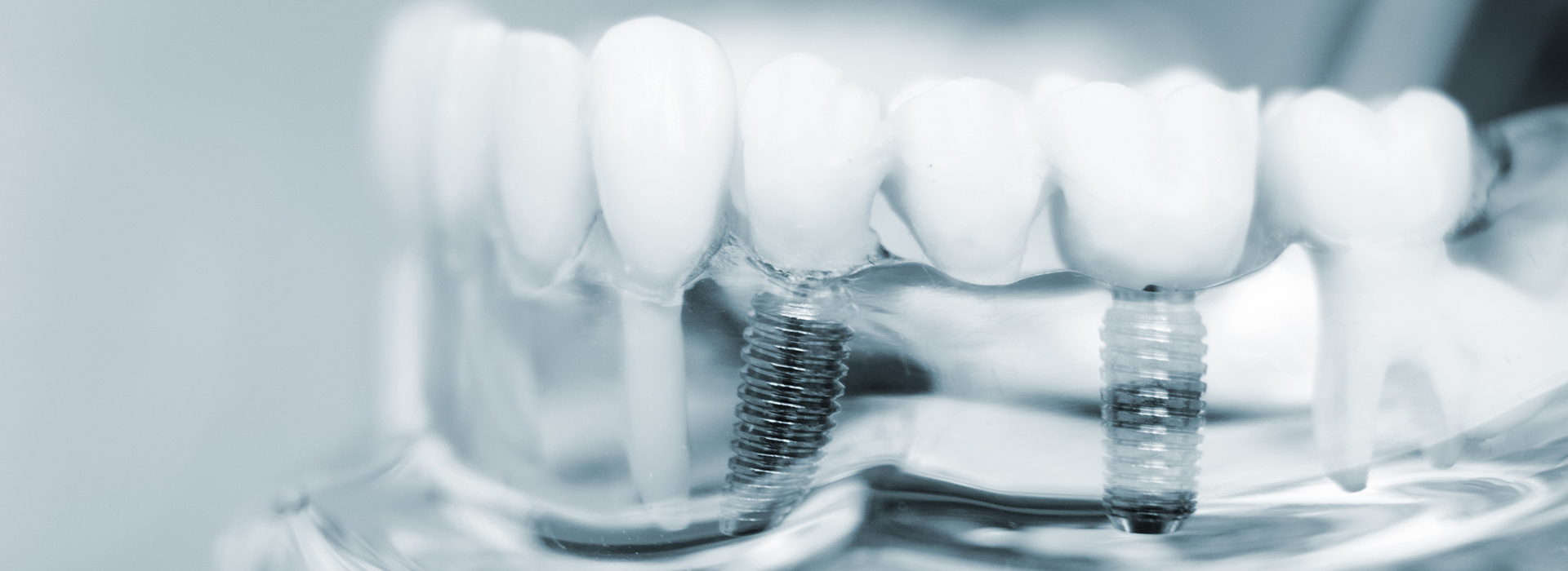 The image shows a close-up view of dental implants with screws visible through transparent plastic, likely for a medical or educational context.