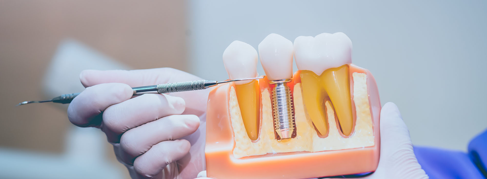 An individual holding a dental implant fixture with a screwdriver, focusing on the task at hand.