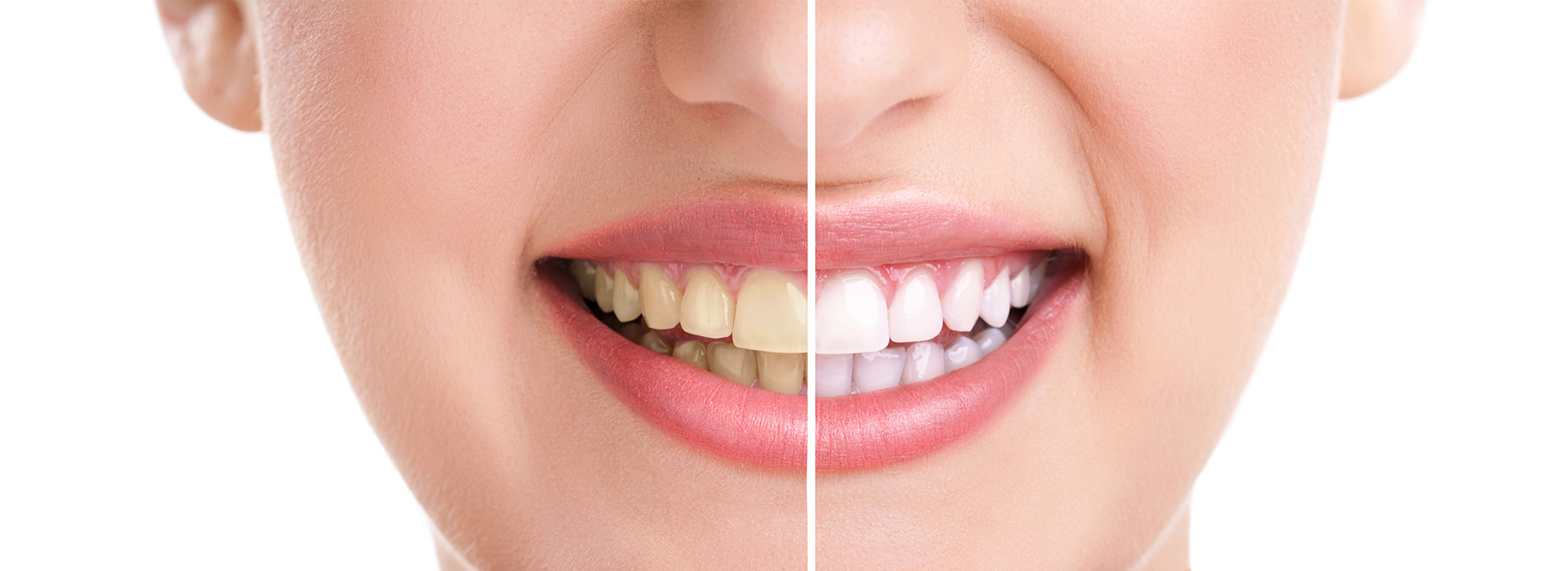 The image shows a close-up of a person s face with a focus on their teeth, which are being straightened by braces, as indicated by a before-and-after comparison graphic.