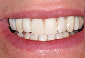 The image displays a close-up of a person s smiling mouth with white teeth.