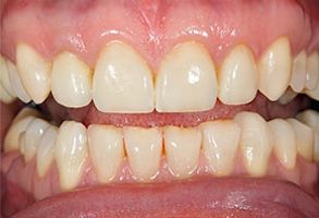 The image shows a close-up of a person s teeth with a focus on their yellowed appearance, likely due to staining or discoloration.