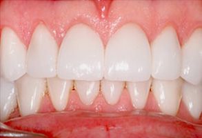 The image displays a close-up view of a person s teeth with a focus on their front teeth, showcasing a bright white smile with clean surfaces and a healthy appearance.