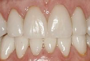 The image shows a close-up view of a person s teeth with a focus on the lower front teeth, which appear to be discolored or stained.