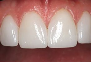 The image shows a close-up view of a person s teeth with a focus on a set of veneers, highlighting their bright white color and smooth surface.