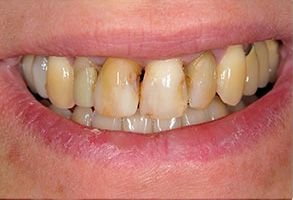 The image shows a close-up view of a person s teeth with a yellowish tint, which could indicate dental issues such as discoloration or staining.