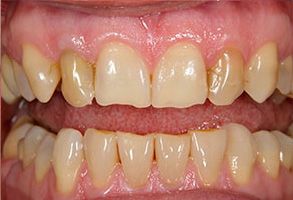 The image shows a close-up view of a person s mouth with teeth showing, featuring a set of yellowed teeth and a pinkish gumline, likely for dental care illustration purposes.
